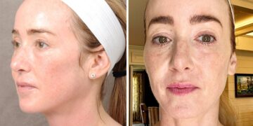 How Can Firm Face Skin: जवानी में स्किन लटकती है, तो इन चार घरेलू नुस्खों से त्वचा को कसावट दें