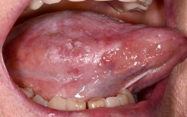 Mouth cancer prevention tips