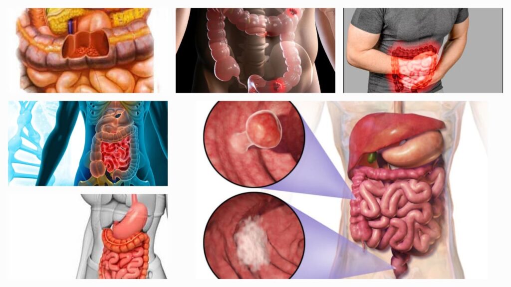 Easy ways to prevent bowel cancer naturally with diet and lifestyle tips