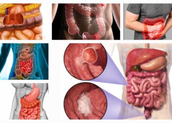 Easy ways to prevent bowel cancer naturally with diet and lifestyle tips