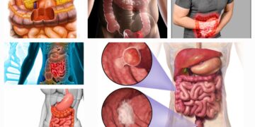 Easy ways to prevent bowel cancer naturally with diet and lifestyle tips