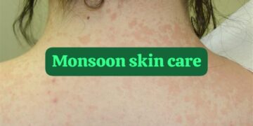 Protect skin from infections during monsoon