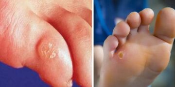 Health News: Foot Corn से घर बैठे कैसे राहत पाएं अपनाएं ये असरदार घरेलू उपाय