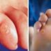 Health News: Foot Corn से घर बैठे कैसे राहत पाएं अपनाएं ये असरदार घरेलू उपाय