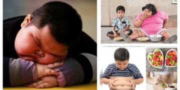 Childhood obesity causes prevention and health impact