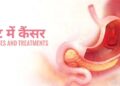 Stomach Cancer : 2008 से 2017 के बीच जन्मे लोगों लिए आई डराने वाली ख़बर, रिपोर्ट में क्या हुआ खुलासा