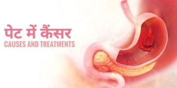 Stomach Cancer : 2008 से 2017 के बीच जन्मे लोगों लिए आई डराने वाली ख़बर, रिपोर्ट में क्या हुआ खुलासा