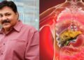 Satish Shah kidney failure causes symptoms treatment