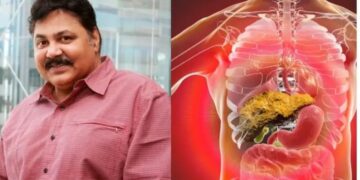 Satish Shah kidney failure causes symptoms treatment