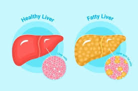 fatty liver