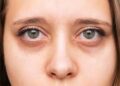 Dark Circles Causes: क्या आंखों के नीचे काले घेरे सिर्फ नींद की कमी से होते हैं? जानिए क्या है इसके पीछे की असली वजह