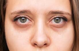 Dark Circles Causes: क्या आंखों के नीचे काले घेरे सिर्फ नींद की कमी से होते हैं? जानिए क्या है इसके पीछे की असली वजह