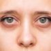 Dark Circles Causes: क्या आंखों के नीचे काले घेरे सिर्फ नींद की कमी से होते हैं? जानिए क्या है इसके पीछे की असली वजह