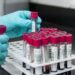 Blood Test for Cancer : भारत पहुंची नई जांच तकनीक, एक ब्लड टेस्ट से 10 तरह के कैंसर की होगी पहचान