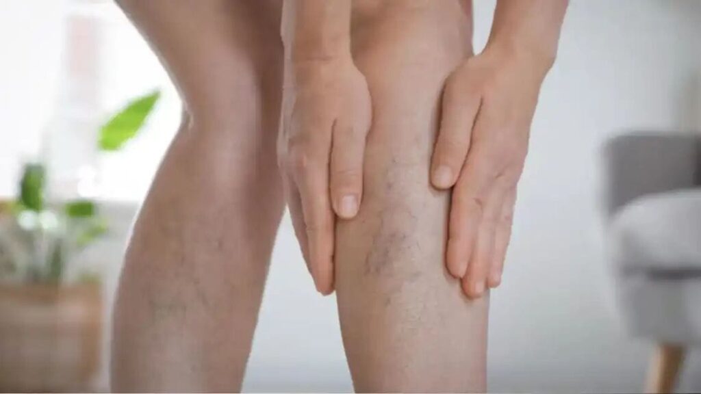 Blue Veins on Legs