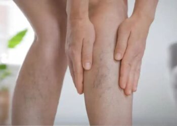 Blue Veins on Legs