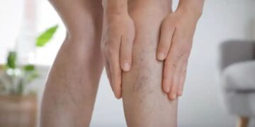 Blue Veins on Legs