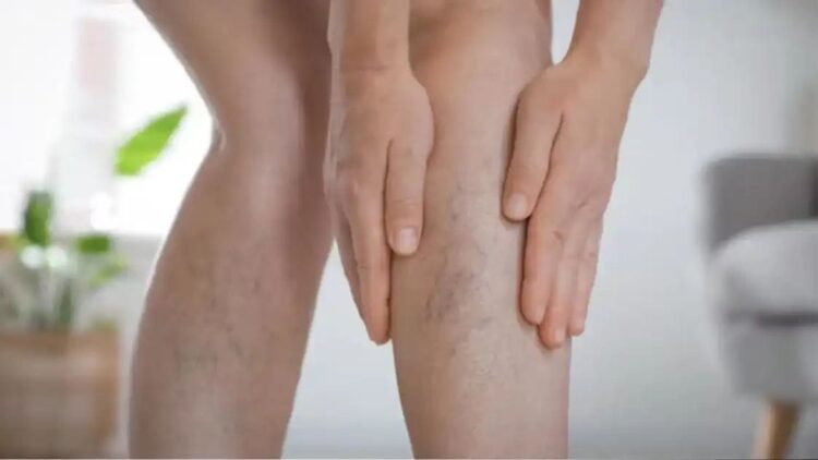 Blue Veins on Legs