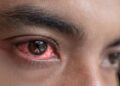 Monsoon Eye Care: बारिश में तेजी से फैलता है Pink Eye इन्फेक्शन,जानें इससे बचने के आसान उपाय