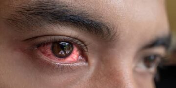 Monsoon Eye Care: बारिश में तेजी से फैलता है Pink Eye इन्फेक्शन,जानें इससे बचने के आसान उपाय